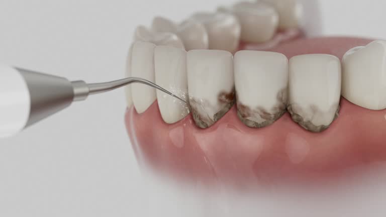 Trusted Wisdom Tooth Removal service in Cambria, IL - Dentist Open Now
